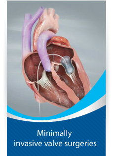 Minimally invasive valve surgeries