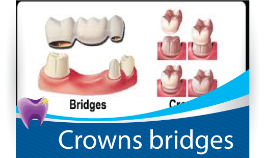 Crowns Bridges