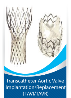 Transcatheter Aortic Valve Implantation/Replacement (TAVI/TAVR)